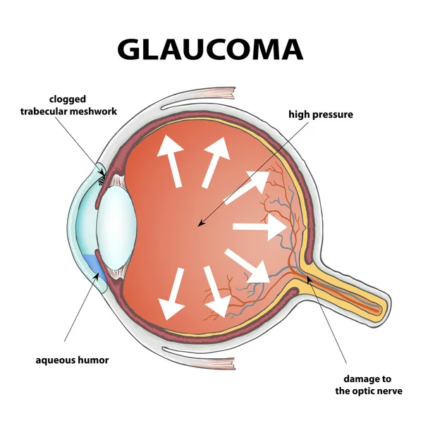 Glaucoma Vector Art Stock Images | Depositphotos